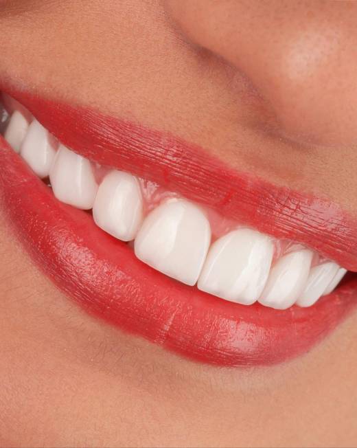 Close-up of a woman smiling with bright, white teeth, representing cosmetic dentistry results